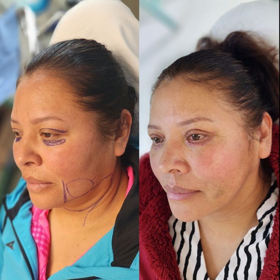 Comparación antes y después de una paciente, con marcaje prequirúrgico a la izquierda