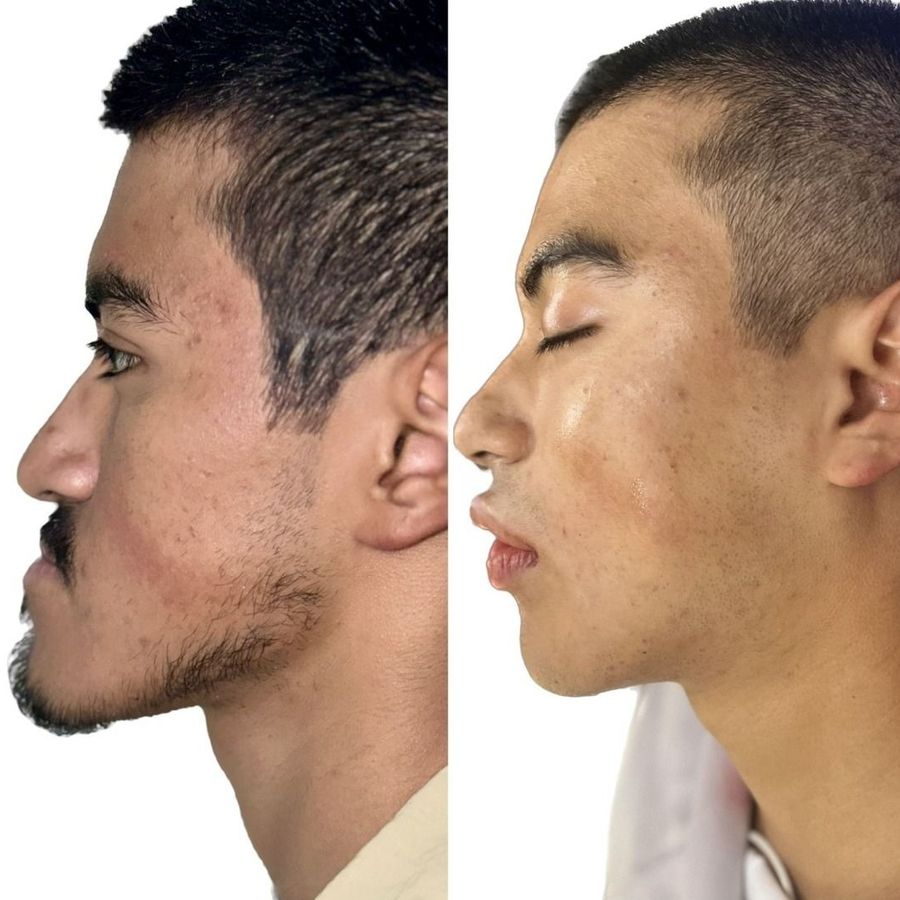 Comparación antes y después en vista de perfil de un paciente masculino