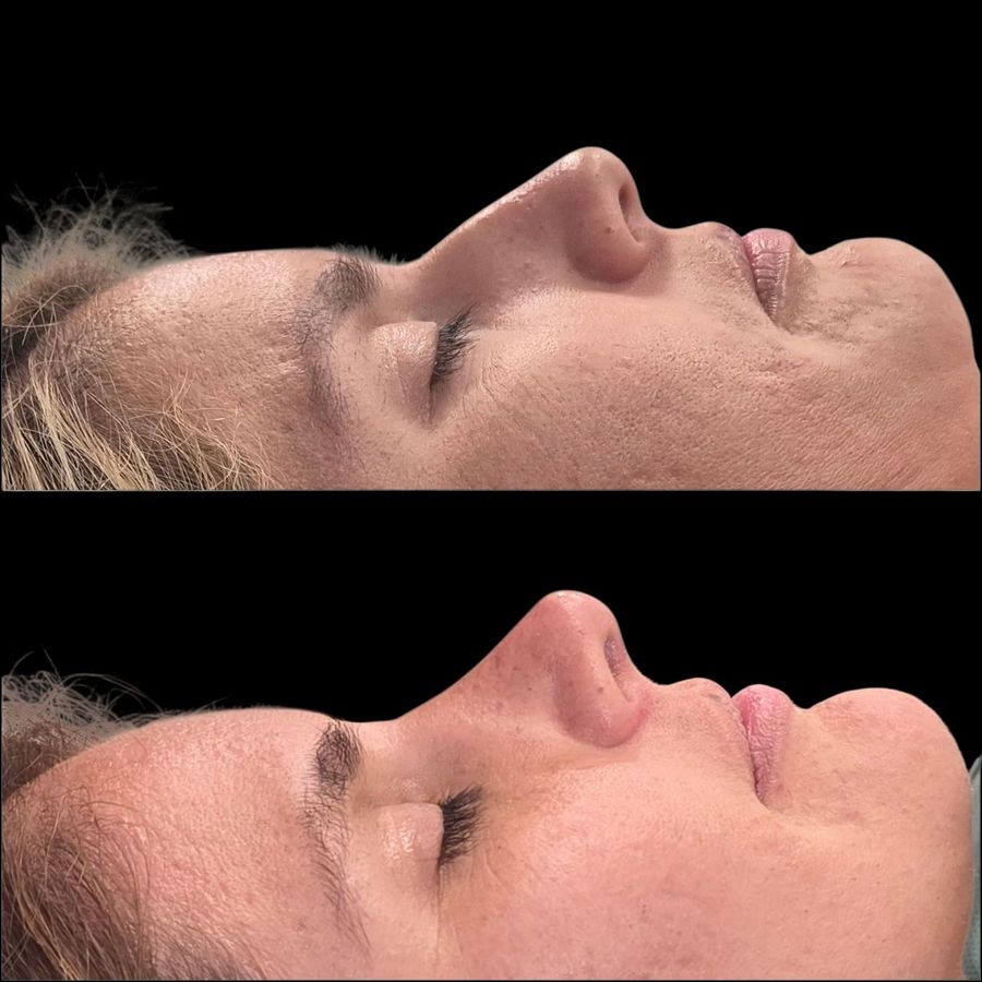 Comparación antes y después en vista de perfil de una paciente