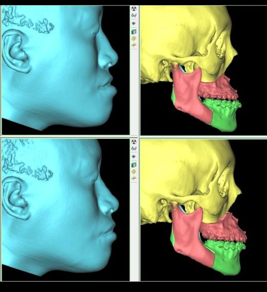 Planeación virtual 3D de cirugía ortognática: rostro y estructura ósea antes y después del movimiento de los maxilares